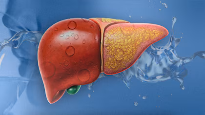 Hígado Graso vs. Inflamación Hepática: Causas, Síntomas y la Importancia del Diagnóstico Oportuno